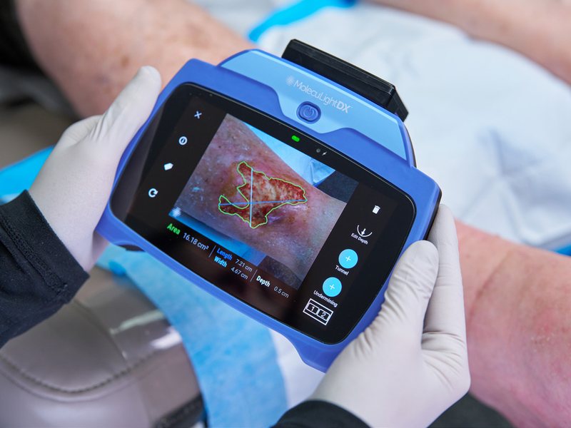 MolecuLight DX handheld fluorescence imaging device held in gloved hands at the bedside, showing a measured wound image on its screen